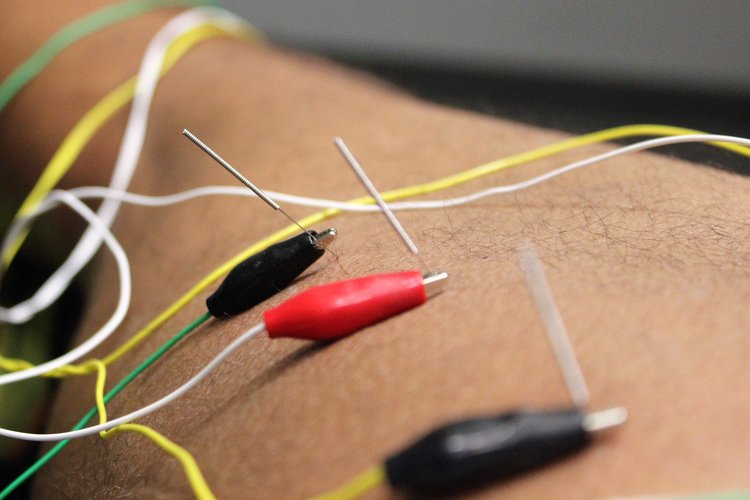 Dry Needling