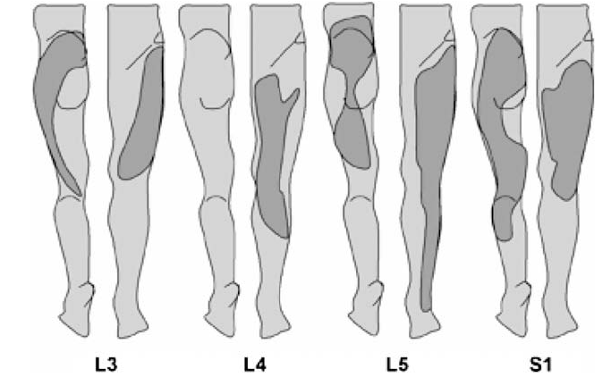 Lumbar Disc Pain Referral