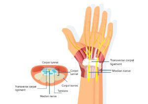 Read more about the article Carpal Tunnel Syndrome