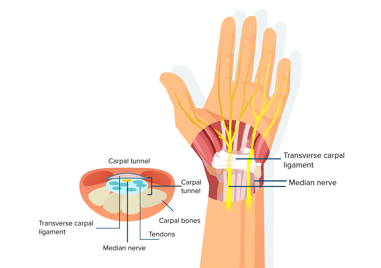 You are currently viewing Carpal Tunnel Syndrome