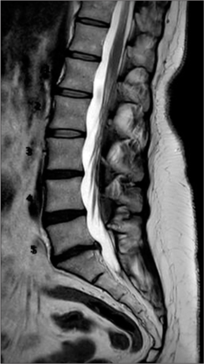 Do Chiropractors Treat Disc Herniations Omne Chiropractic